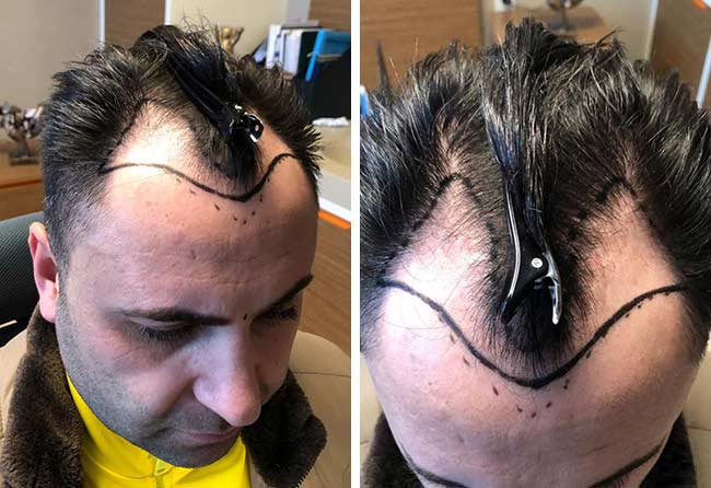 Antes Do Transplante cabelo FUE Safira 4200 folículos do Murat K.jpg