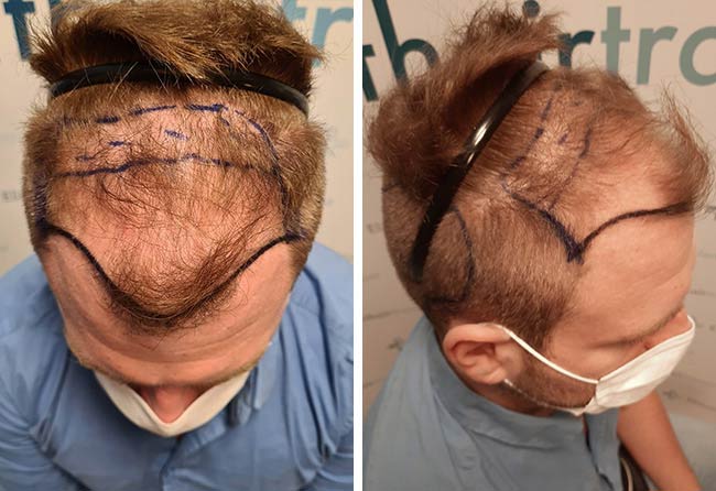 Antes Transplante cabelo FUE safira 4500 folículos do Kewin Lenzig