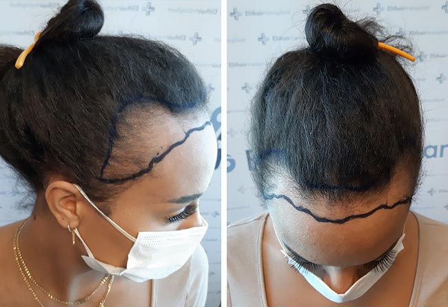 Antes Transplante cabelo mulher FUE SDHI 3200 folículos do Jahy C