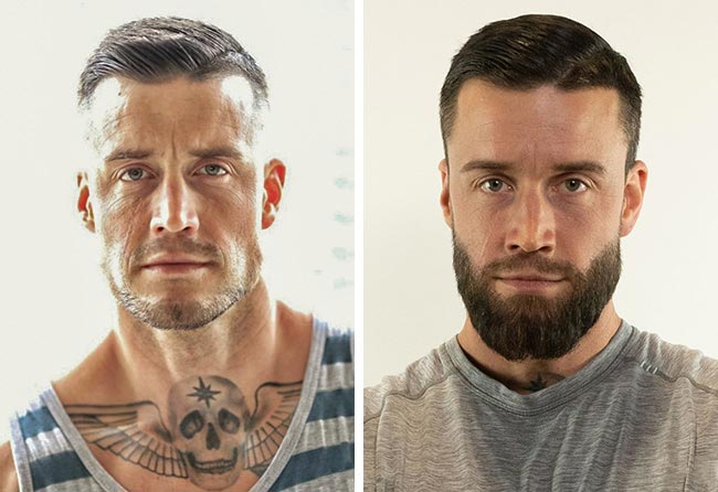 Antes depois Transplante barba 4200 folículos do Jhaki