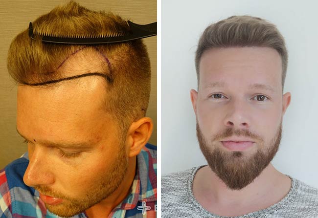 Antes e Depois Transplante cabelo FUE safira 2800 folículos do Alexander Kitzel