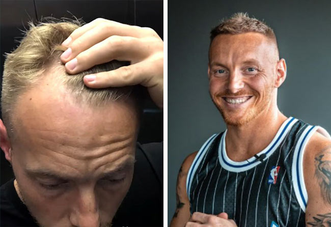 Antes e Depois Transplante cabelo FUE safira 3100 folículos do Coach Stef