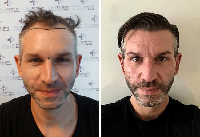 Antes e Depois Transplante cabelo FUE safira 4250 folículos do Thomas Schreier