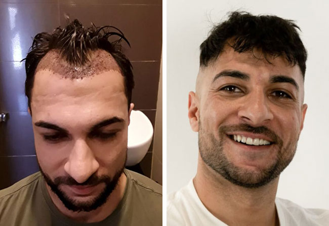 Antes e Depois Transplante capilar 2200 folículos do Osmani_Perparim