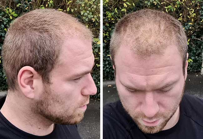 Depois 1 mes Transplante cabelo FUE safira 4500 folículos do Kewin Lenzig