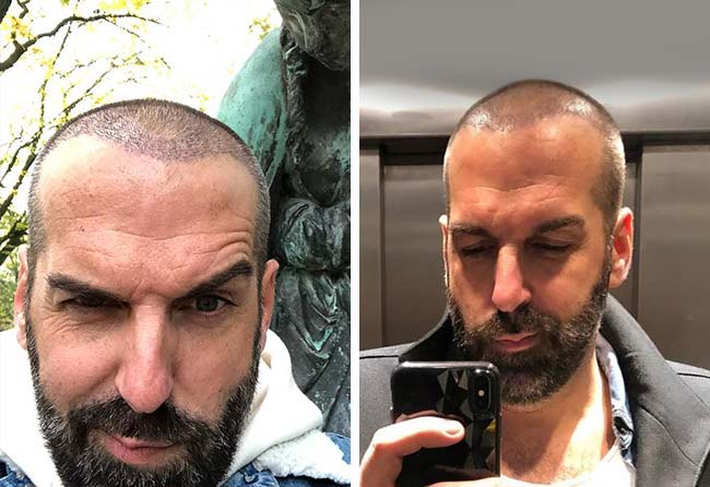 Depois 2 meses Transplante cabelo FUE safira 3400 folículos do Jürgen T