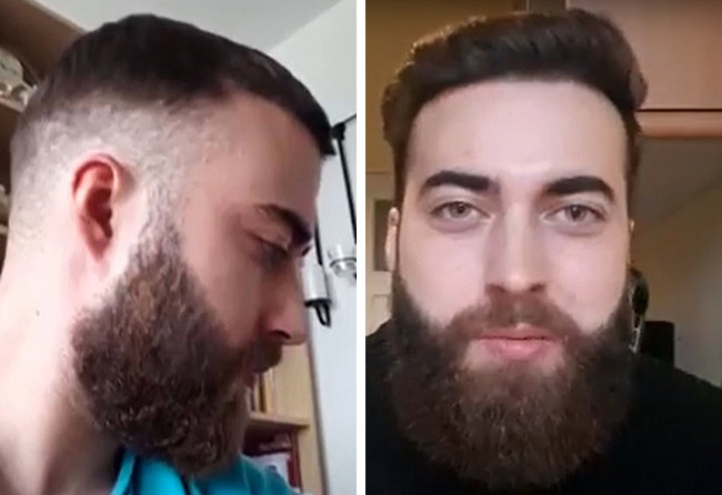 Resultado Depois Transplante barba FUE safira 4250 folículos do Andre Ulbrich