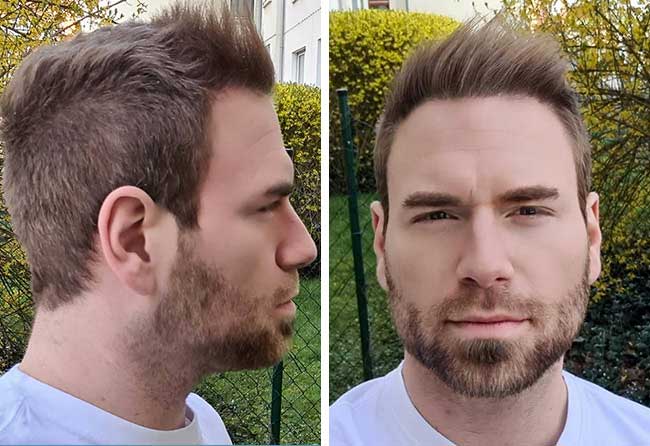 Resultado Depois Transplante cabelo FUE safira 4500 folículos do Kewin Lenzig