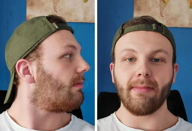 Resultado do Transplante Barba FUE safira 3250 folículos do Sascha Lockemann.jpg