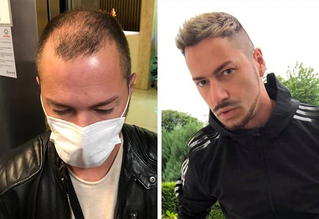 Antes e Depois Transplante cabelo FUE DHI 5200 folículos do Andre O.