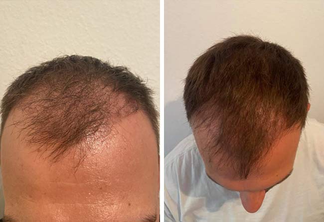 3 meses depois transplante capilar safira 4500-grafts-Sefket-Ahmetovic