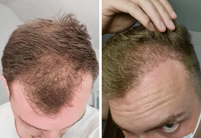 4 meses despois transplante capilar FUE Safira 4200-grafts-Marc-Stehr