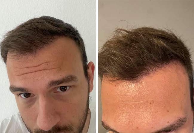 6 meses depois transplante capilar safira 4500-grafts-Sefket-Ahmetovic