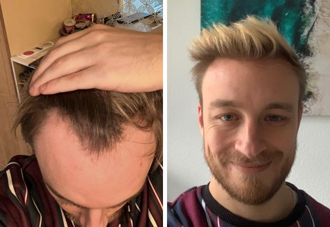 Antes e depois transplante capilar DHI-4200-grafts-Marius-Schmiddi