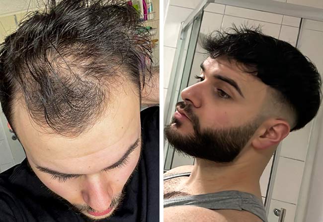 Antes e depois transplante capilar DHI-4700-grafts-Okan-Yueksel