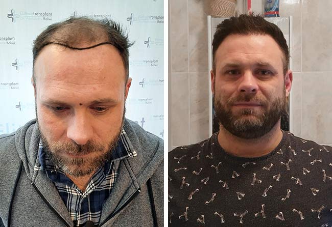 Antes e depois transplante capilar percutaneo-3700-grafts-Michael-Woulfe