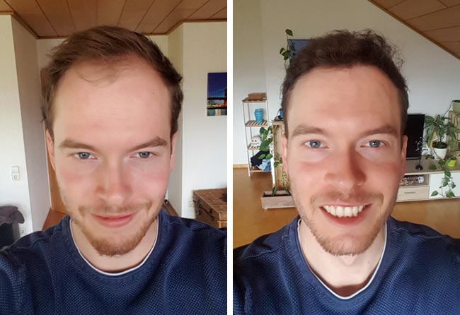 Antes e despois transplante capilar DHI -3500-grafts-Lukas-jaeger