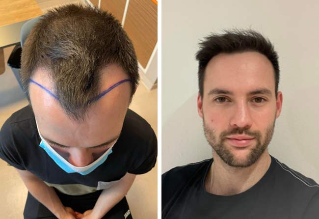 Antes e despois transplante capilar FUE Safira-2700-grafts-Alexander-Volwerk