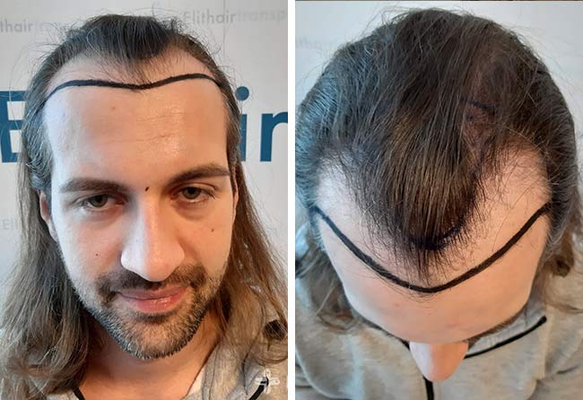 Antes do transplante capilar FUE Safira 4000 grafts do Cagatay Türkseven