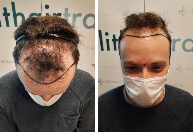 Antes transplante capilar FUE Safira 4500 grafts do Didac Scheffler