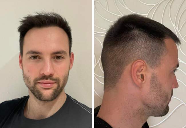 Resultado depois transplante capilar FUE Safira-2700-grafts-Alexander-Volwerk