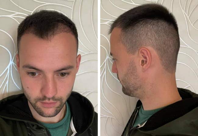 2 meses depois transplante capilar FUE Safira 2700 Grafts Thorsten S.