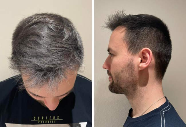 5 meses depois transplante capilar FUE Safira 2700 grafts Thorsten S.