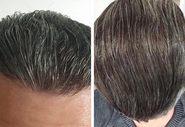 Depois-Transplante-cabelo-FUE-safira-3100-foliculos-do-Dani-el