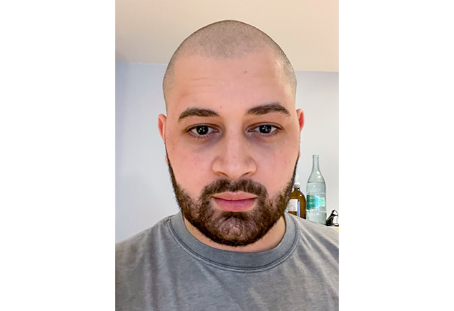 Resultado Depois Transplante barba FUE safira 3750-enxertos - mohammed-e