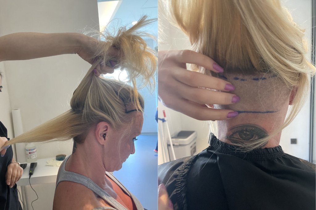 Depilação parcial de um transplante de cabelo feminino a Elithair