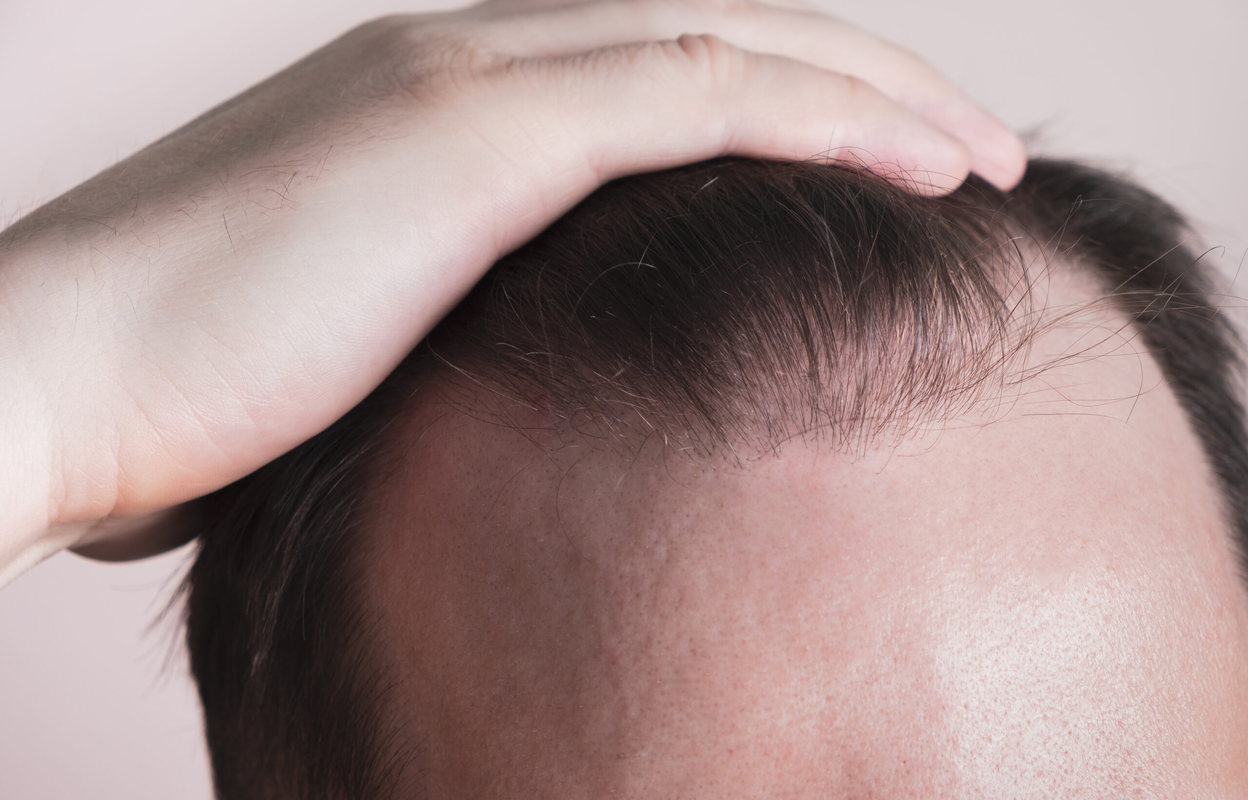 homem com uma mão na cabeça mostrando a linha frontal do cabelo