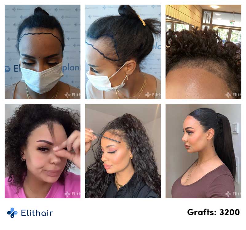 Antes e depois do transplante capilar para mulheres de Jahy C na Elithair.