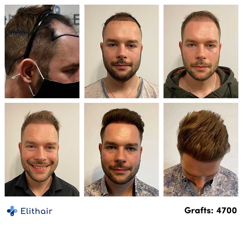 Antes depois do transplante capilar DHI 4700 enxertos paciente Michael na Elithair.