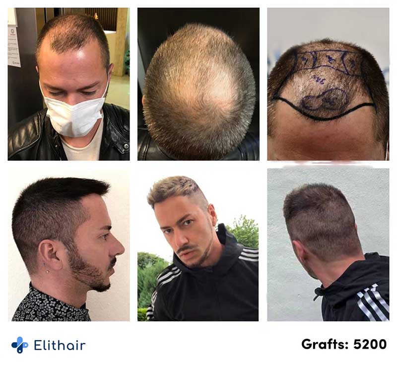 Antes e depois do transplante capilar de Andre O. na Elithair