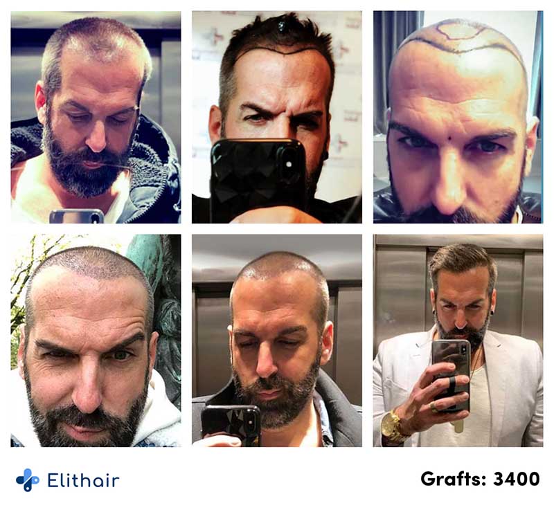 Antes depois do transplante capilar foi elithair paciente Juergen 3400 enxertos na Elithair.