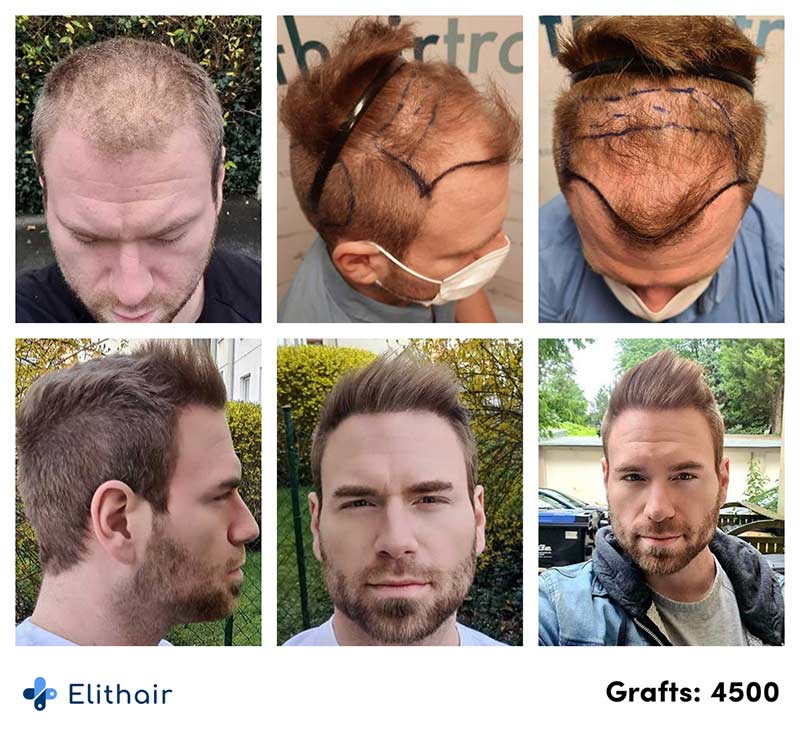 Antes e depois do transplante capilar de Kewin L. na Elithair.