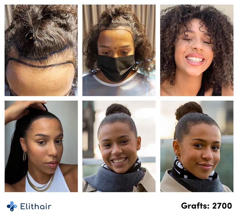 Antes e depois do transplante capilar para mulheres de Melissa Zerhau na Elithair.