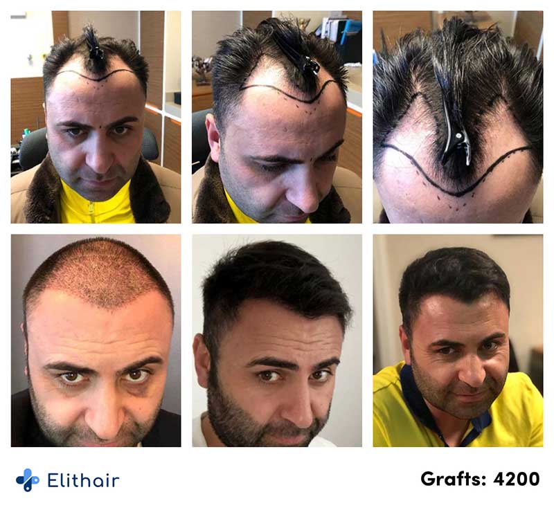 Antes o depois transplante capilar FUE Safira Murat K. na Elithair