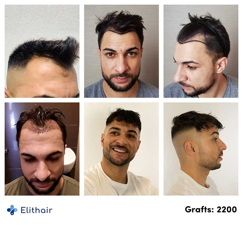 Antes o depois transplante capilar FUE safira Osmani P. na Elithair.