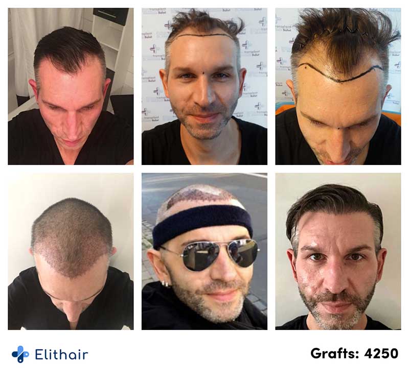 Antes e depois do transplante capilar de Thomas S. na Elithair