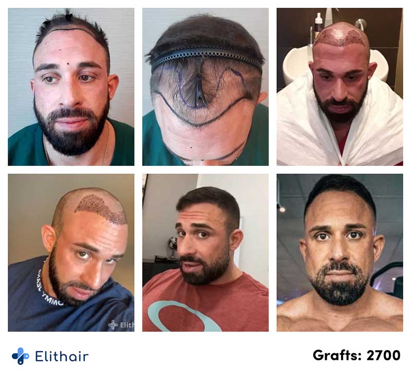 Antes e depois do transplante capilar de Kevin Wolte na Elithair.