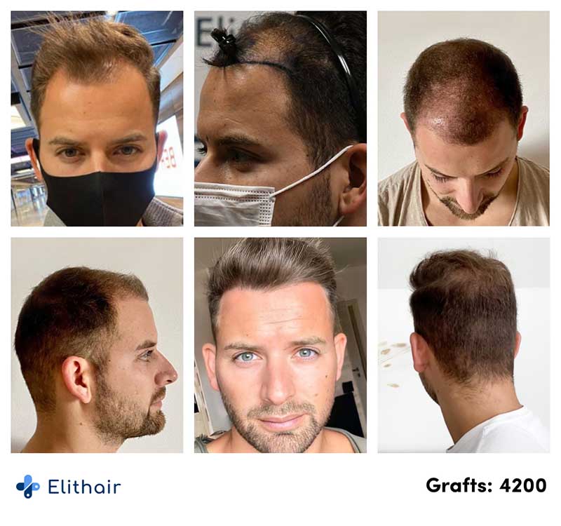 Antes e depois do transplante capilar de Marcel Oliva na Elithair