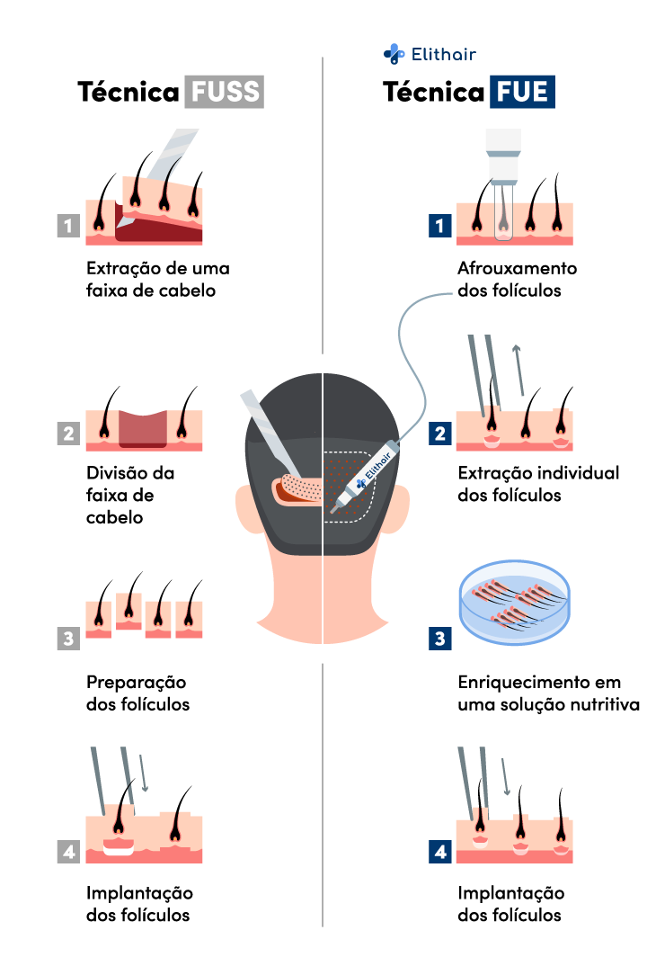 Comparação de técnicas de FUT e FUE.