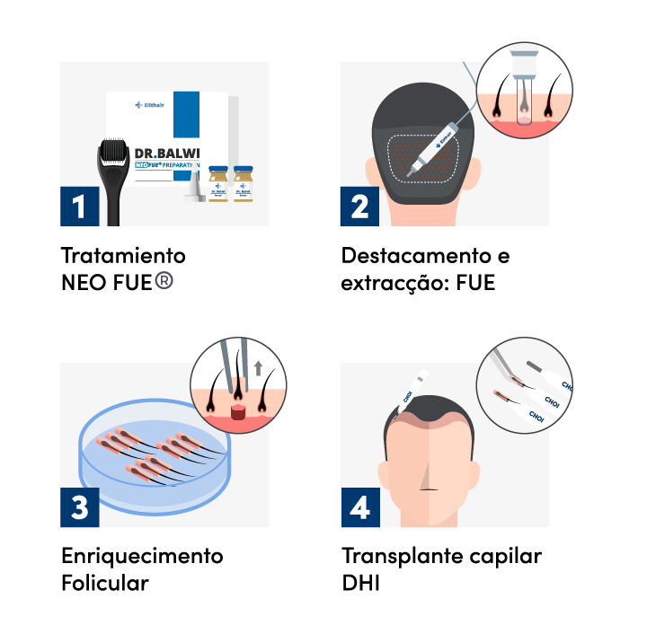 Imagem gráfica dos 4 passos de um procedimento de transplante capilar com a técnica DHI na Elithair.