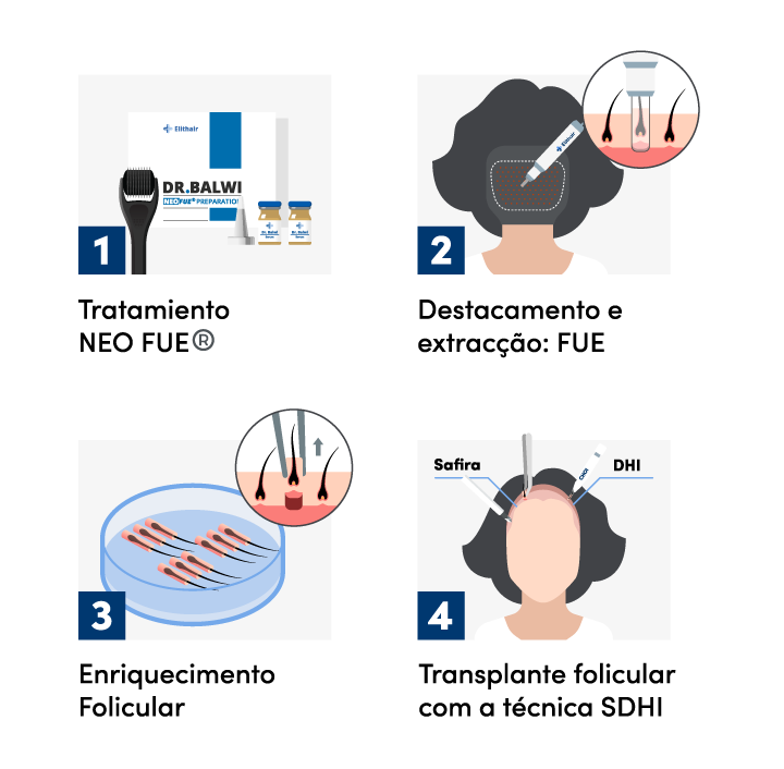 Imagem gráfica dos 4 passos de um procedimento de transplante capilar para mulheres na Elithair.