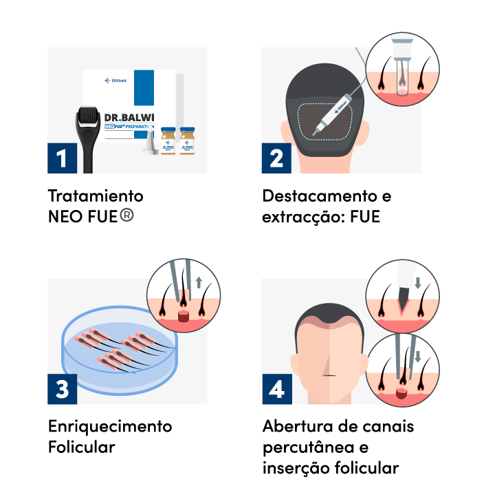 Infográfico do processo de um transplante capilar com a técnica percutânea na Elithair