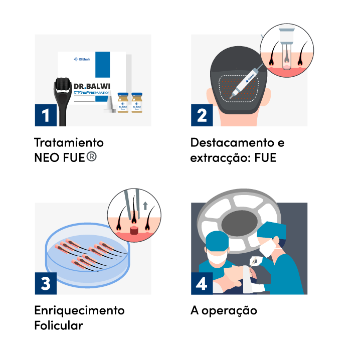 Infográfico da extracção de folículos da área doadora utilizando a técnica FUE na Elithair.
