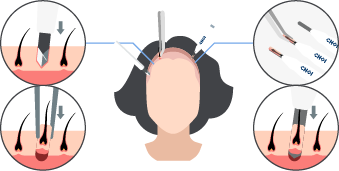 Implementação com o método SDHI