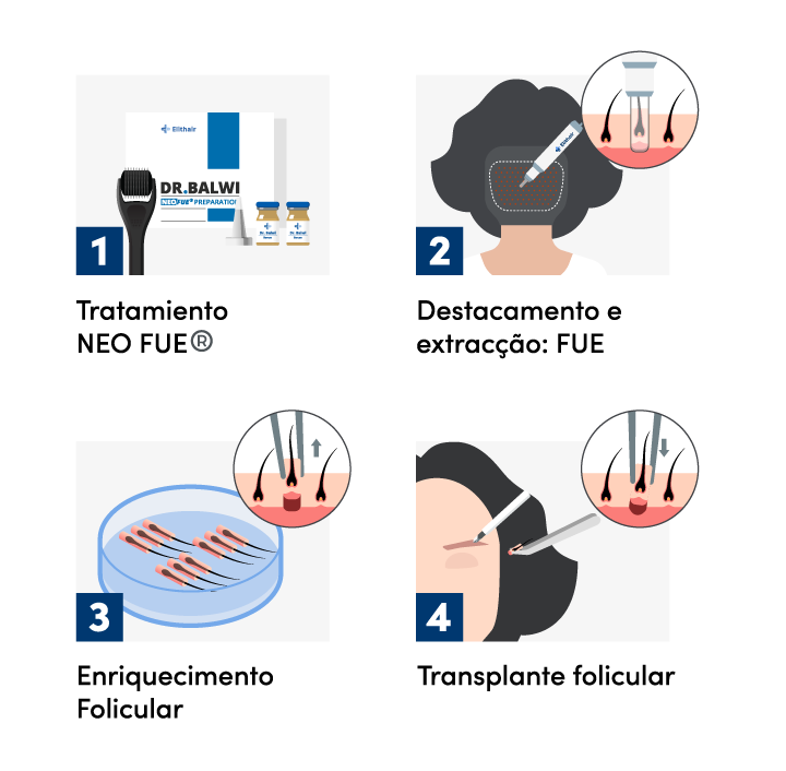 Imagem gráfica do procedimento de implante de sobrancelhas na Elithair.