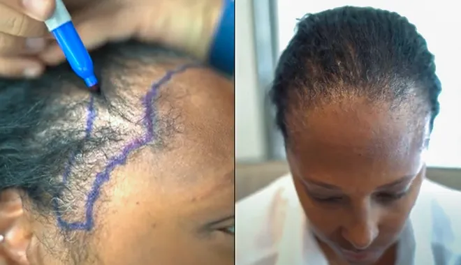 O transplante capilar pode ser realizado para corrigir a alopecia de tração